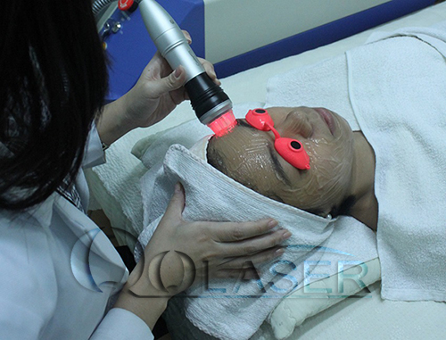 cong-nghe-laser-acnes.jpg