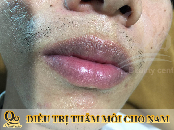 dieu-tri-tham-moi-cho-namJPG.JPG