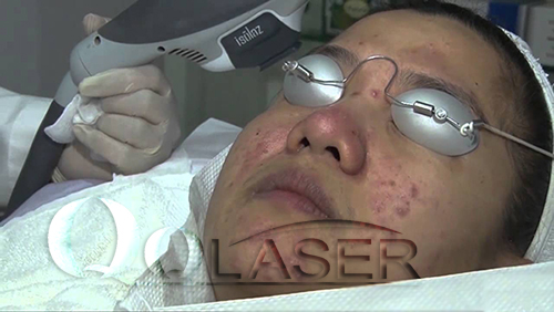 may-laser-acne-tri-mun.jpg